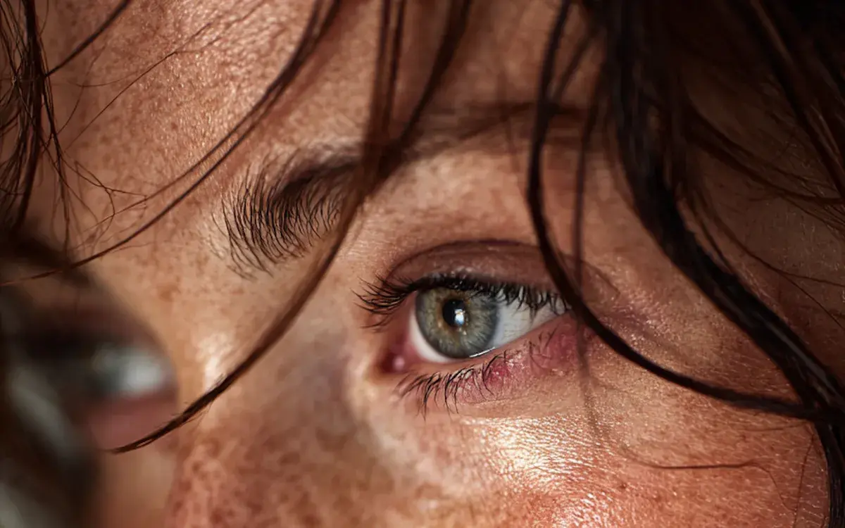 Stye treatment and prevention — Prospela skincare